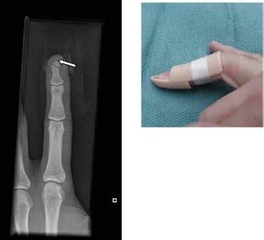 Distal Phalanx Tuft Fracture