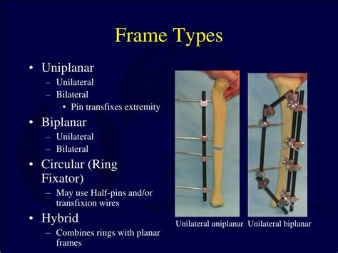 PPT - Principles of External Fixation PowerPoint Presentation, free download - ID:3201240