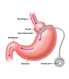 The laparoscopic adjustable gastric band The ‘LAP-BAND’ - Tri State Bariatrics, Middletown ...