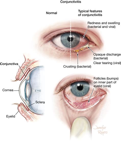 Conjunctivitis | External Eye Disease | JAMA | The JAMA Network