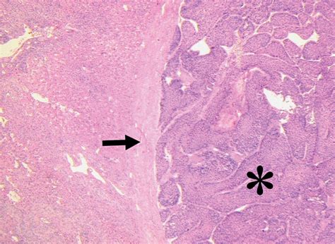 Focal Nodular Hyperplasia Histology | SexiezPicz Web Porn