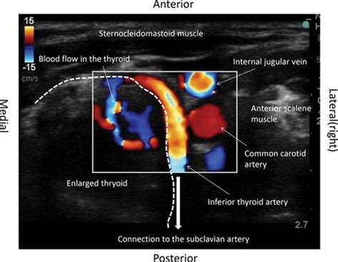 Detection of Large Inferior Thyroid Artery by Ultrasound Prescan before Internal Jugular Vein ...