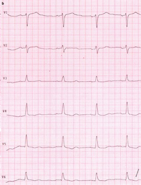 Wide QRS Complex Tachycardias | Thoracic Key