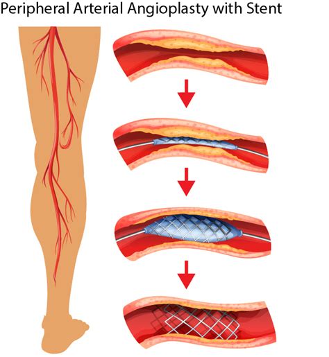 Peripheral Arterial Angioplasty Stent Placement - Elite Cardiovascular ...