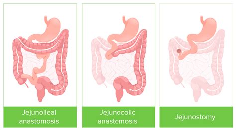 Short Bowel Syndrome | Concise Medical Knowledge