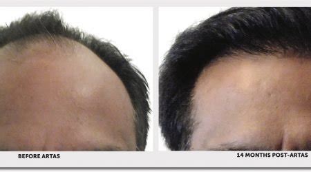 Advanced FUE Hair Transplant Technology - ARTAS