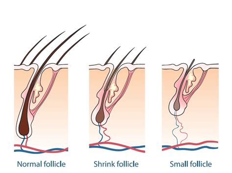 Keratin Causes Hair Loss http://www.hairlossmenwomen.com/keratin-causes-hair-loss/ | Hair loss ...