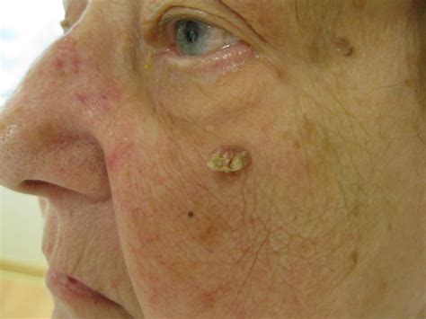 Squamous Cell Carcinoma of the Skin - Dermatology Advisor