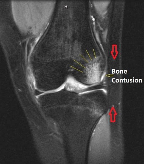 OrthoKids - Basketball Injuries