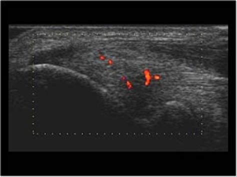 Musculoskeletal Joints and Tendons | 6.2 Elbow : Case 6.2.2 Common flexor tendon insertion and ...