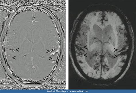 Superficial siderosis | MedLink Neurology