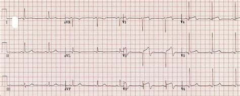 Wellens Syndrome • LITFL • ECG Library Eponym