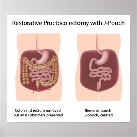 Restorative proctocolectomy