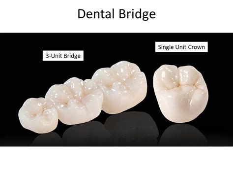 Porcelain Dental Bridges - Dentist Marina del Rey | SmileOn Dentistry