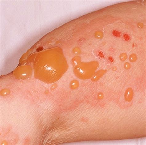 Bullous Pemphigoid: Symptoms, Causes and Treatments | New Health Advisor