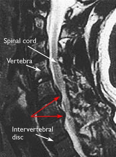 Cervical Radiculopathy (Pinched Nerve) - OrthoInfo - AAOS