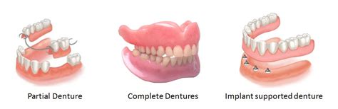 Types of Dentures: Complete, Partial and Semi-Precision Dental Implants ...