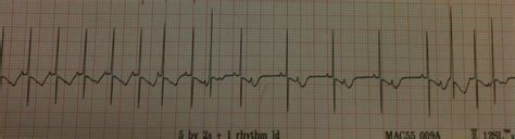 Pedi cardiology: EKG - Interpret this