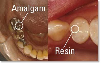 Welcome ~Lucy's~ to the Truth: Truth about Dentist Mercury Fillings ...