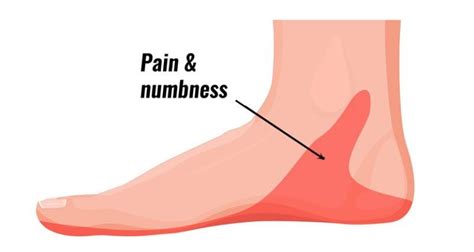 Tarsal Tunnel Syndrome : Cause, Symptoms, Diagnosis, Treatment