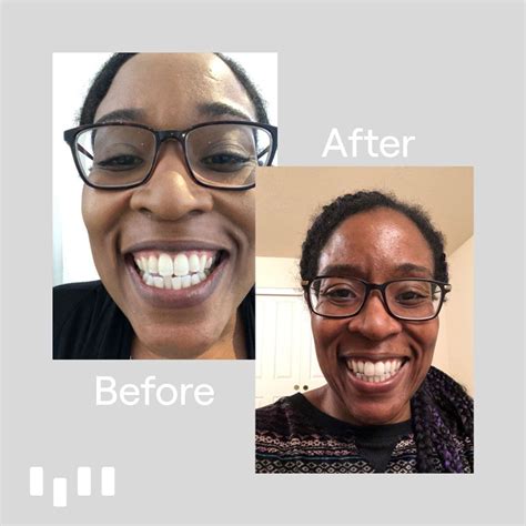 Check out Karen's Before & After in 2020 | Teeth straightening, Clear aligners, Traditional braces