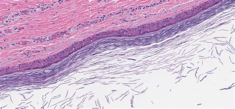 Epidermoid Cyst