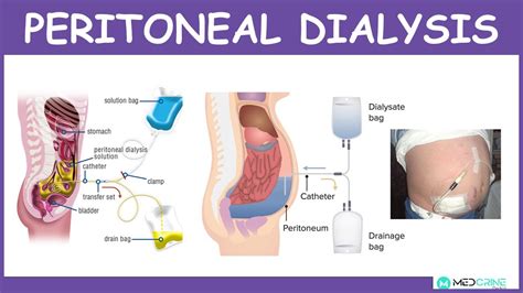 Peritoneal Dialysis: Introduction, Physiology, Technique, Modes and Complications - YouTube