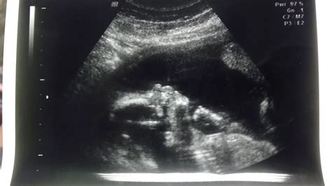 20 Week Anatomy Scan/Ultrasound & GENDER REVEAL!!! Boy or Girl? You ...