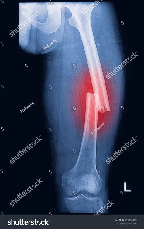 Broken Human Thigh Xrays Image Left Stock Photo 123265486 - Shutterstock