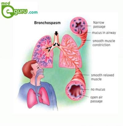 Asthma Attack | Bronchospasm | Obstructive lung diseaseMed E Guru