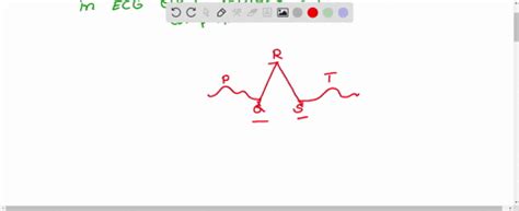 ⏩SOLVED:The QRS complex of a normal ECG results from (A) atrial… | Numerade