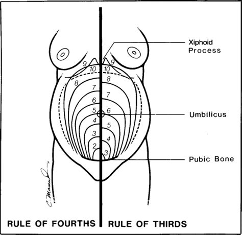 Measurement of Fundal Height - Journal of Obstetric, Gynecologic & Neonatal Nursing