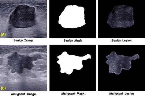 Breast Ultrasound Image Database - QAMEBI