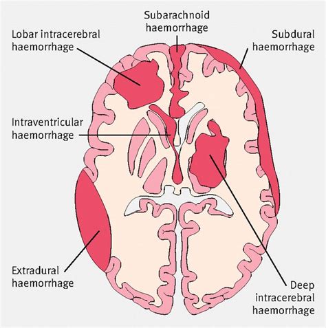 17 Best images about EMS: Neurology on Pinterest | Intracranial hemorrhage, Seizure disorder and ...