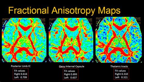 Dr Balaji Anvekar FRCR: Understanding Primary Dystonia with Advanced MRI Sequences