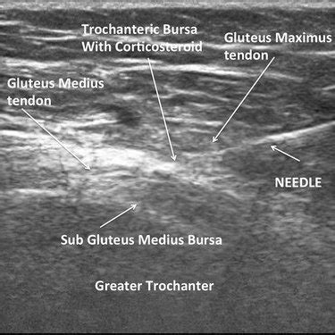 Ultrasound identification of the trochanteric bursa. The greater... | Download Scientific Diagram