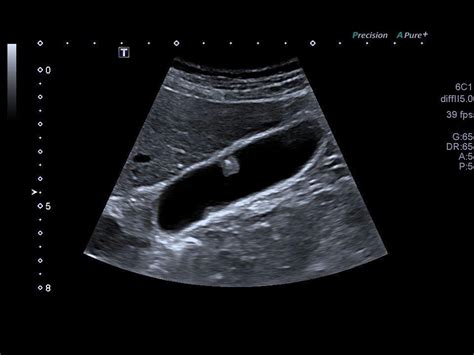 Gallbladder Polyps Ultrasound