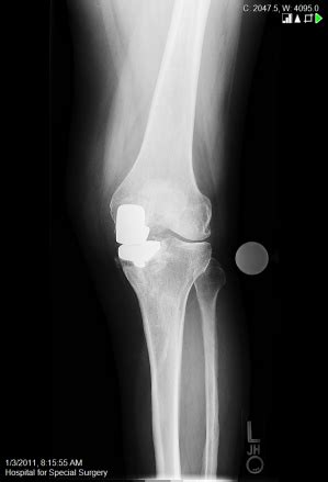 Partial Knee Replacement - Unicondylar Knee Replacement