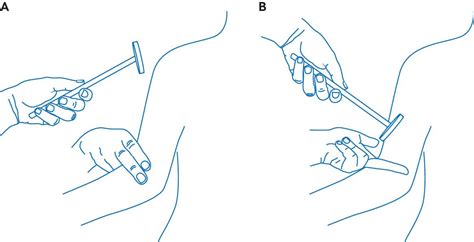 Quadriceps Reflex