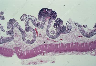 LM of human colonic polyps (tubular adenomas) - Stock Image - M108/0083 - Science Photo Library