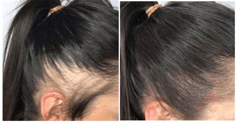 What to Expect: Scalp Micropigmentation Treatment for Women