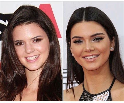 Kendall Jenner before and after | Kendall jenner nose job, Kendall ...