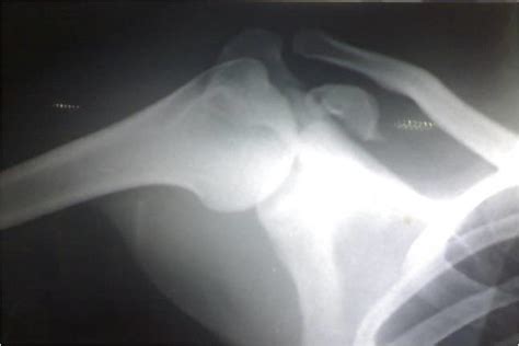 Case 1, X-ray showing fractured coracoid process and undisplaced... | Download Scientific Diagram