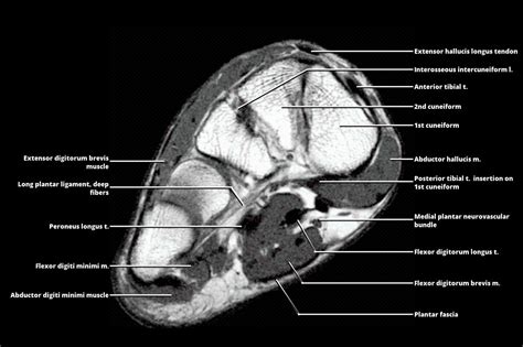 MRI - FOOT