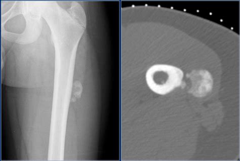 The Radiology Assistant : Bone tumor P-Z