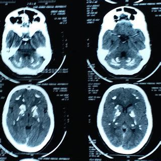 NCCT head of patient on day of admission. | Download Scientific Diagram