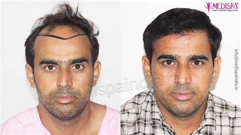 Details more than 72 hair transplant surgeon in mumbai - in.eteachers