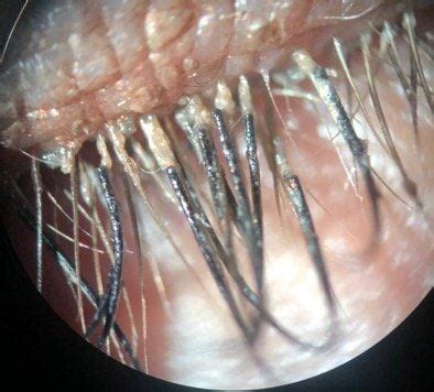 Eyelash Mites: Identifying Symptoms, Getting Rid of Them