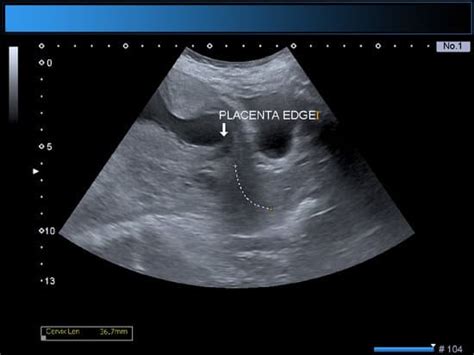 Identical twin boys obstetrical ultrasound - Photos by Canva