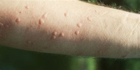 What Are Heat Hives And How Do You Get Rid Of Them? | HuffPost | What ...